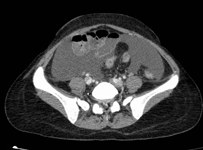 Acute Budd-Chiari syndrome (Radiopaedia 60858-68638 Axial C+ portal venous phase 214).jpg