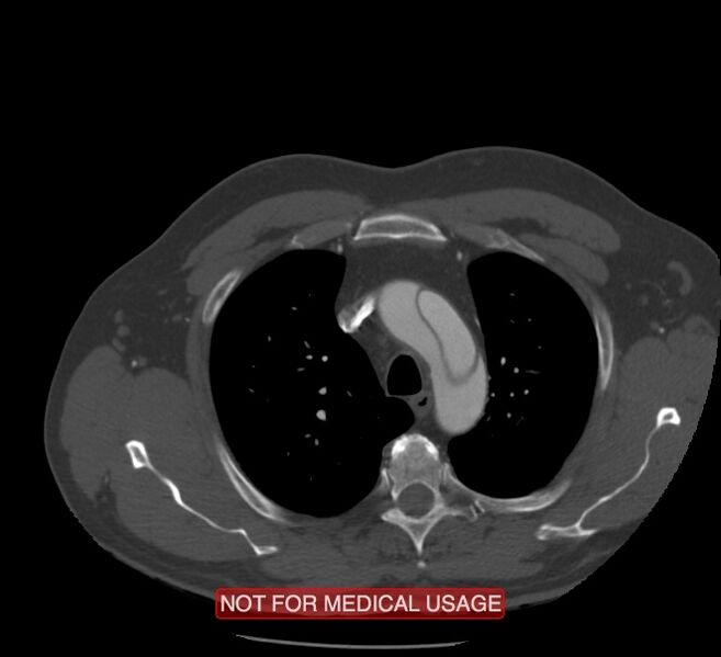 File:Acute aortic dissection - Stanford type A (Radiopaedia 40661-43285 Axial C+ arterial phase 5).jpg
