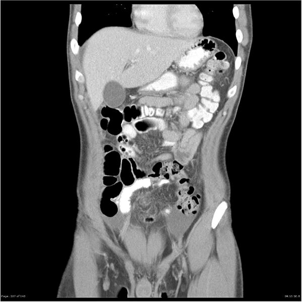 File:Acute appendicitis (Radiopaedia 25364-25615 C+ portal venous phase 4).jpg