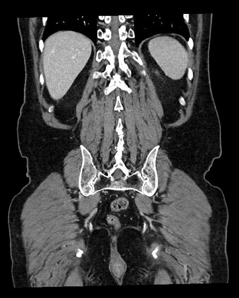 File:Acute appendicitis - large appendicoliths (Radiopaedia 61805-69820 Coronal C+ portal venous phase 108).jpg