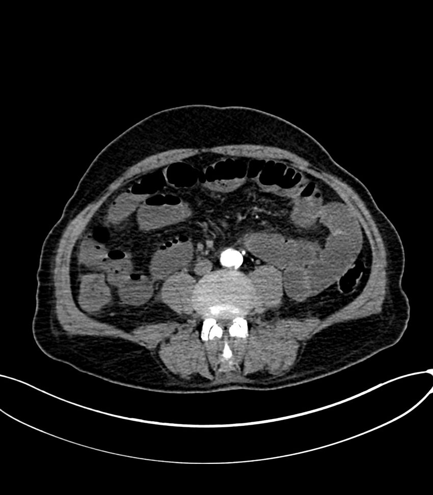 Acute arterial mesenteric ischemia (Radiopaedia 78238-90828 Axial C+ arterial phase 79).jpg