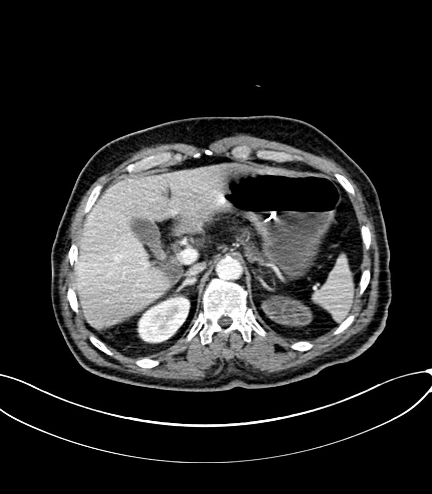 Acute arterial mesenteric ischemia (Radiopaedia 78238-90828 Axial C+ portal venous phase 37).jpg