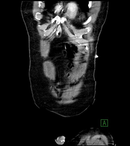 File:Acute arterial mesenteric ischemia (Radiopaedia 78238-90828 Coronal C+ portal venous phase 18).jpg