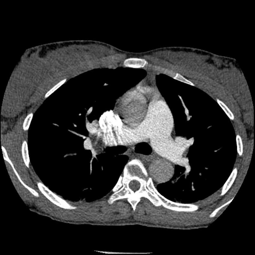 Acute chest syndrome - sickle cell disease (Radiopaedia 42375-45499 Axial C+ CTPA 74).jpg