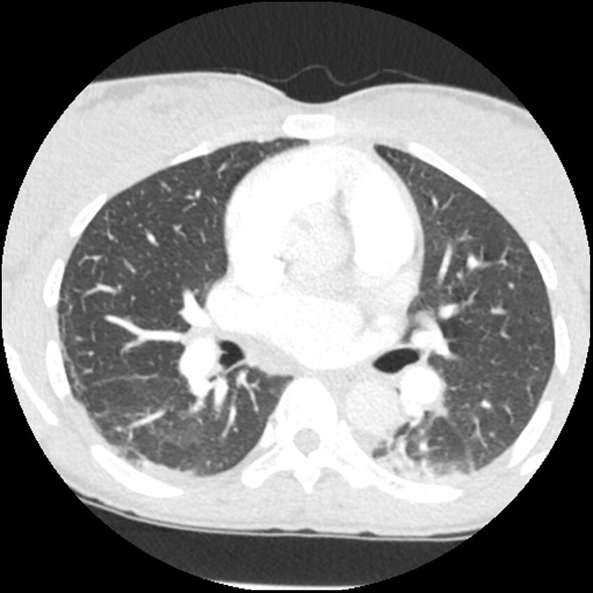 Acute chest syndrome - sickle cell disease (Radiopaedia 42375-45499 Axial lung window 93).jpg