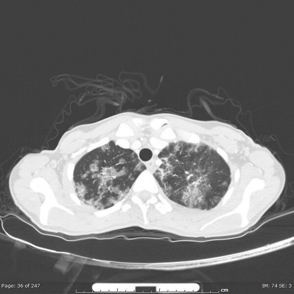 File:Acute eosinophilic pneumonia (Radiopaedia 48211-53073 Axial lung window 13).jpg