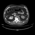 Acute heart failure (CT) (Radiopaedia 79835-93075 Axial C+ arterial phase 113).jpg