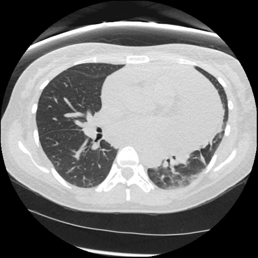 Acute lupus nephritis (Radiopaedia 45832-50107 Axial lung window 47).jpg