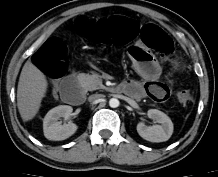 File:Acute mesenteric ischemia - superior mesenteric artery thrombosis (Radiopaedia 73947-84776 Axial C+ arterial phase 35).jpg