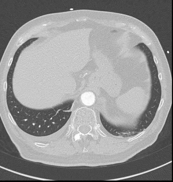 File:Acute myocardial infarction (Radiopaedia 23413-23481 lung window 65).jpg