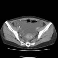 Acute myocarditis (Radiopaedia 55988-62613 Axial C+ portal venous phase 65).jpg