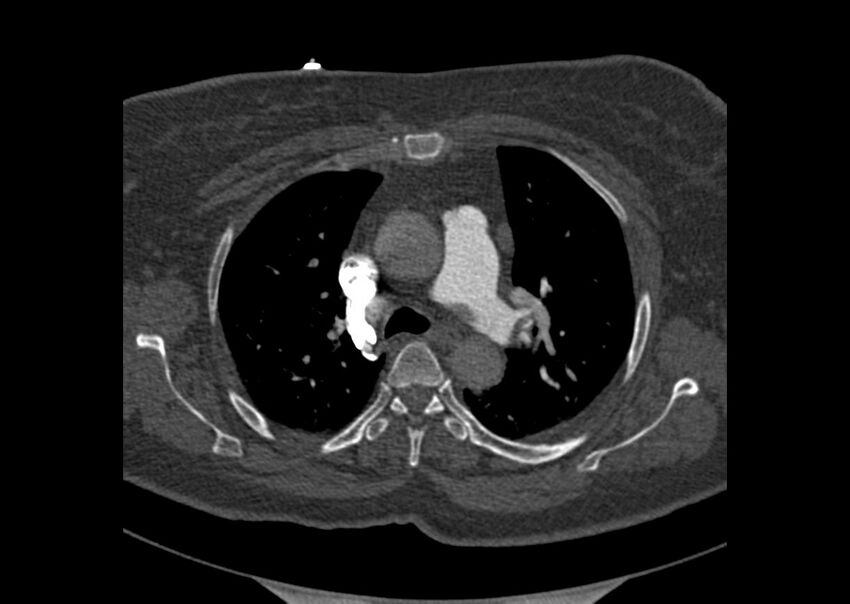 Acute pulmonary embolism (Radiopaedia 29938-30466 Axial C+ CTPA 27).jpg