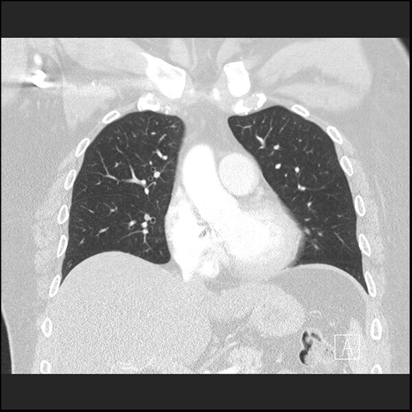 File:Acute pulmonary embolism with pulmonary infarct (Radiopaedia 73062-83768 Coronal lung window 30).jpg