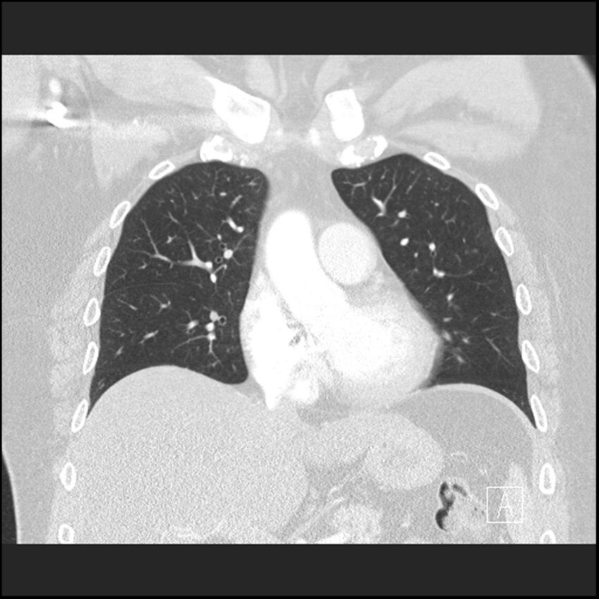 Acute pulmonary embolism with pulmonary infarct (Radiopaedia 73062-83768 Coronal lung window 30).jpg