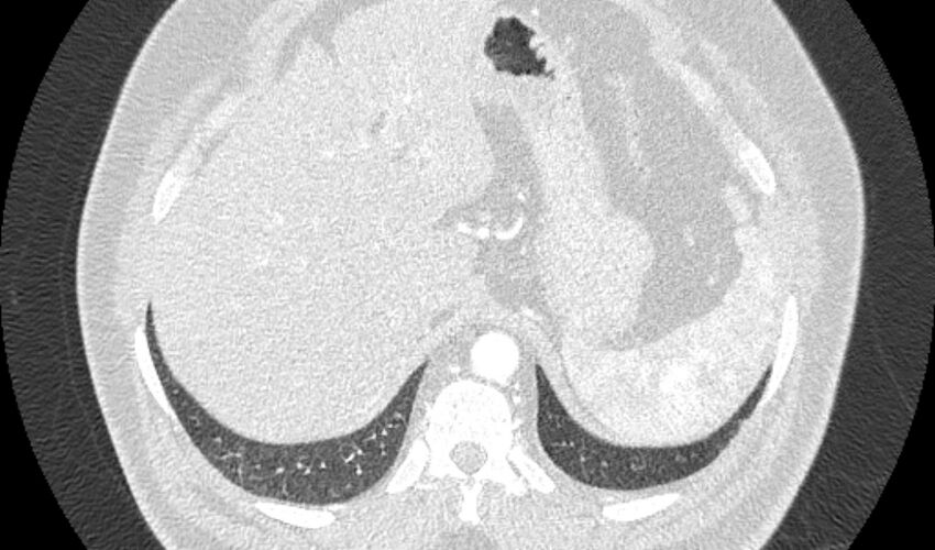Acute pulmonary embolism with pulmonary infarcts (Radiopaedia 77688-89908 Axial lung window 128).jpg