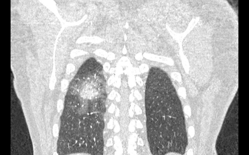 File:Acute pulmonary embolism with pulmonary infarcts (Radiopaedia 77688-89908 Coronal lung window 93).jpg