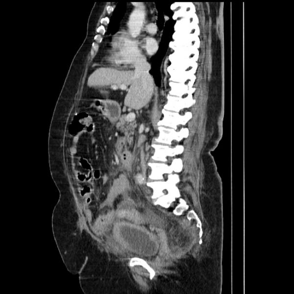 File:Acute pyelonephritis (Radiopaedia 25657-25837 Sagittal renal parenchymal phase 39).jpg