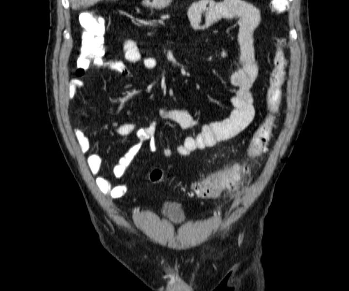 File:Acute sigmoid colon diverticulitis (Radiopaedia 55507-61976 Coronal C+ portal venous phase 34).jpg