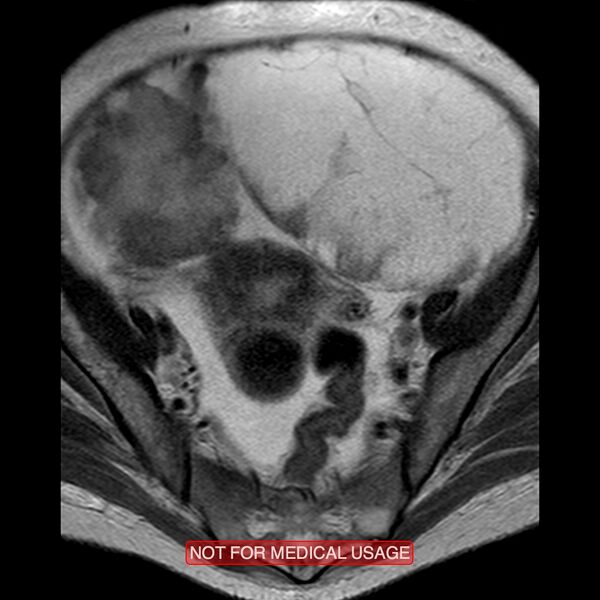 File:Adenocarcinoma of the cervix (Radiopaedia 28373-28615 Axial T2 16).jpg