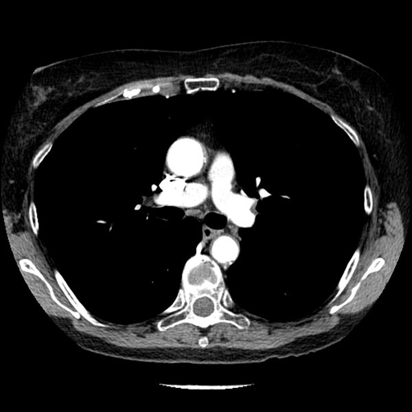 File:Adenocarcinoma of the lung (Radiopaedia 41015-43755 Axial C+ portal venous phase 50).jpg