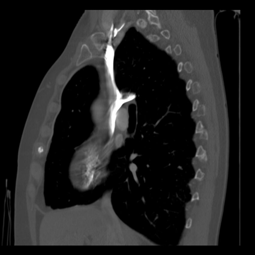 Adenocarcinoma of the lung (Radiopaedia 41015-43755 Sagittal bone window 43).jpg