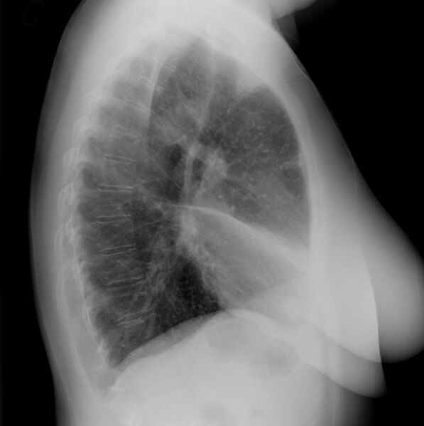File:Adenocarcinoma of the lung (Radiopaedia 44205-47802 Lateral 1).jpg