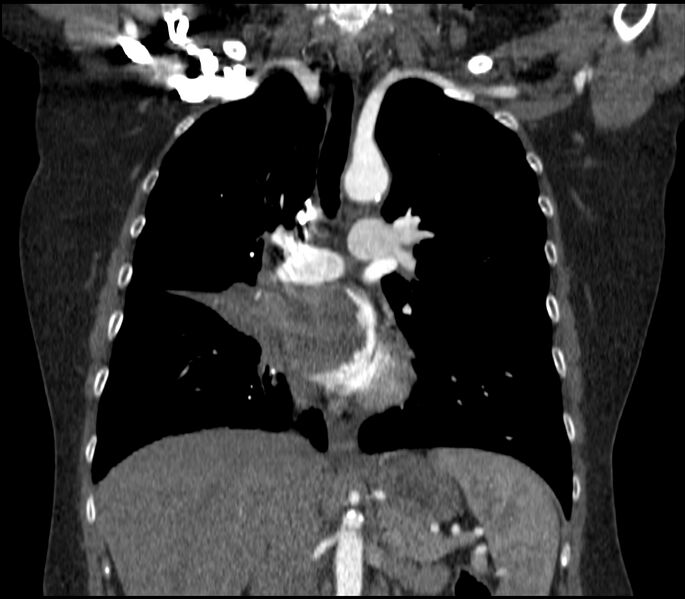 File:Adenocarcinoma of the lung (Radiopaedia 44205-47803 Coronal C+ portal venous phase 44).jpg