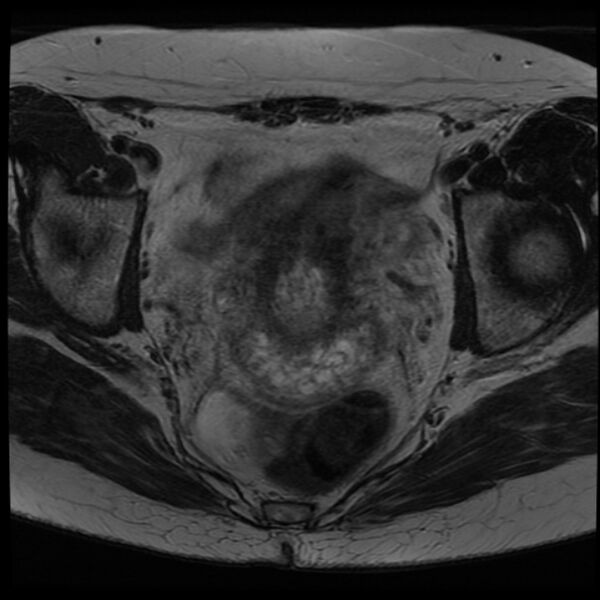 File:Adenoma malignum of the cervix (Radiopaedia 24460-24765 C 12).jpg