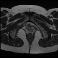 Adenoma malignum of the cervix (Radiopaedia 24460-24765 C 27).jpg