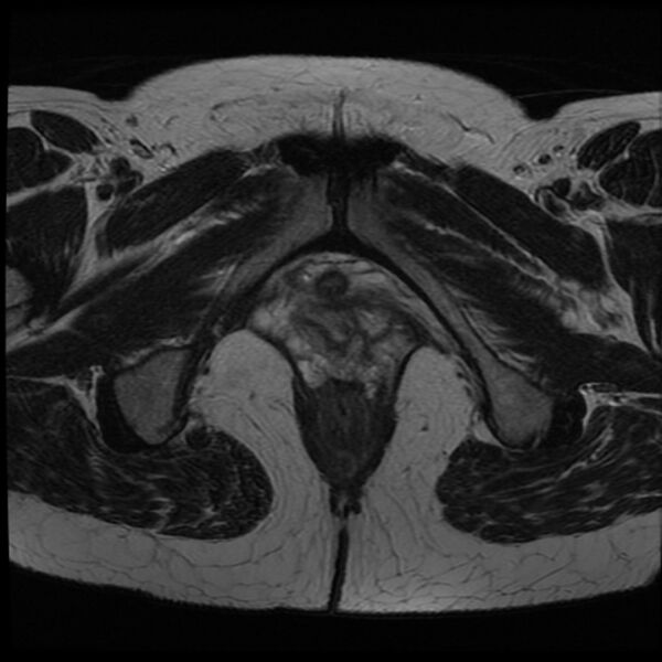 File:Adenoma malignum of the cervix (Radiopaedia 24460-24765 C 27).jpg