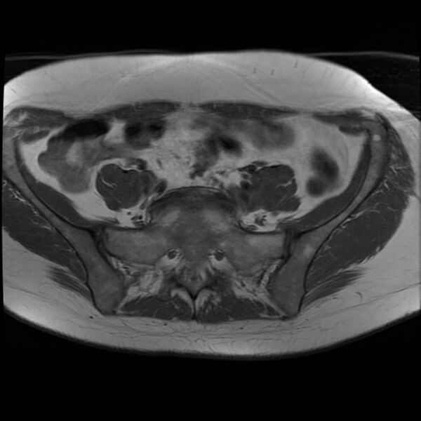 File:Adenoma malignum of the cervix (Radiopaedia 24460-24765 T1 1).jpg
