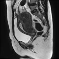 Adenomyosis - ovarian endometriomas (Radiopaedia 67031-76350 Sagittal T2 15).jpg