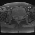 Adenomyosis and endometriotic cysts (Radiopaedia 82300-96367 Axial T1 fat sat 3).jpg