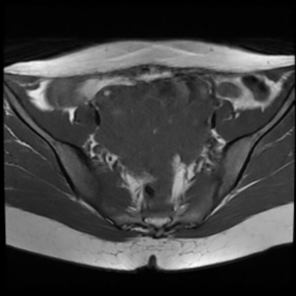 File:Adenomyosis within a septate uterus (Radiopaedia 69963-79981 Axial T1 12).jpg