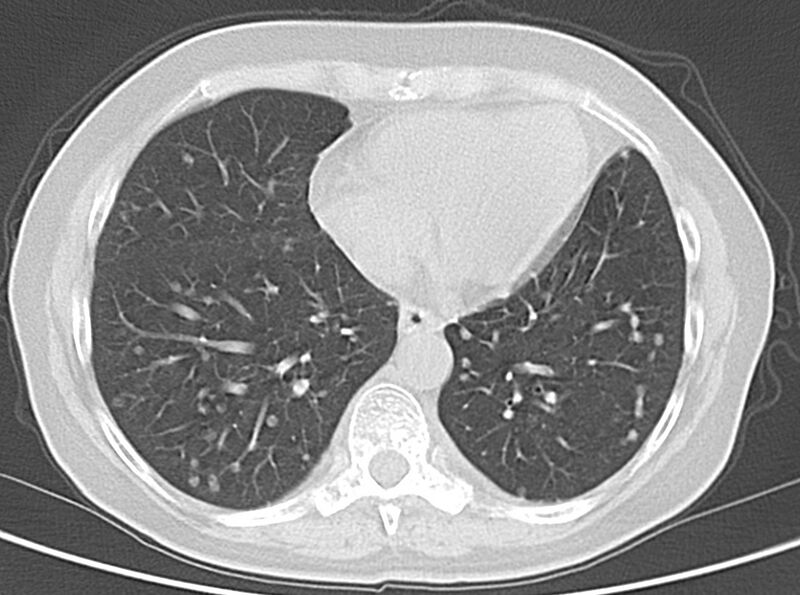 File:Adenosquamous lung carcinoma (Radiopaedia 22035-22030 lung window 42).jpg