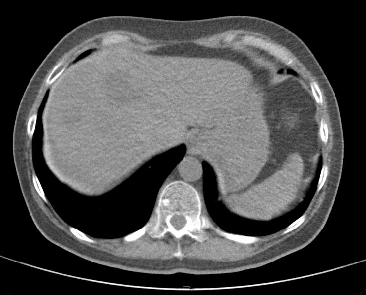 File:Adenosquamous lung carcinoma (Radiopaedia 22035-22030 non-contrast 52).jpg