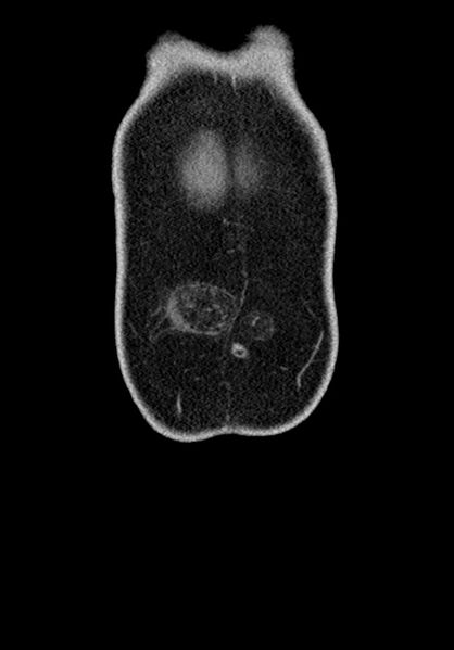 File:Adhesional small bowel obstruction (Radiopaedia 58900-66131 Coronal C+ portal venous phase 50).jpg