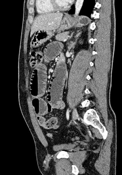 File:Adhesional small bowel obstruction (Radiopaedia 58900-66131 Sagittal C+ portal venous phase 149).jpg