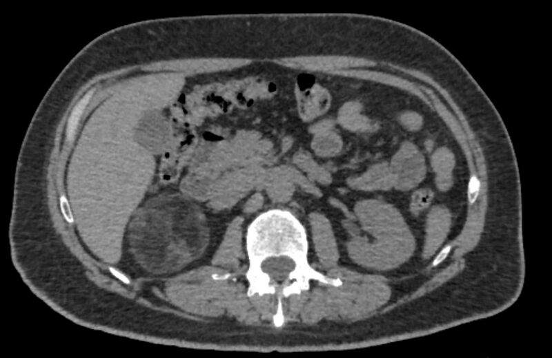 File:Adrenal myelolipoma (Radiopaedia 65240-74253 Axial non-contrast 53).jpg