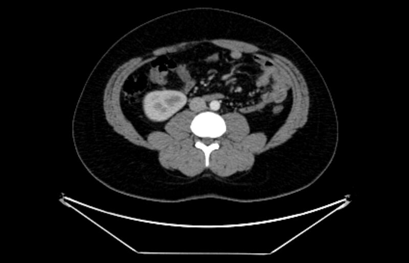 File:Adrenocortical carcinoma (Radiopaedia 80134-93438 Axial C+ portal venous phase 71).jpg