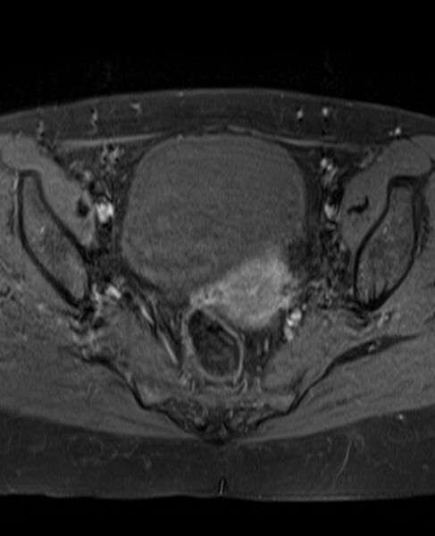 File:Adult granulosa cell tumor of the ovary (Radiopaedia 71581-81950 Axial T1 C+ fat sat 15).jpg