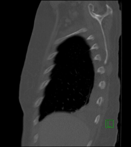 File:Amiodarone deposition in the liver (Radiopaedia 77587-89780 Sagittal bone window 82).jpg