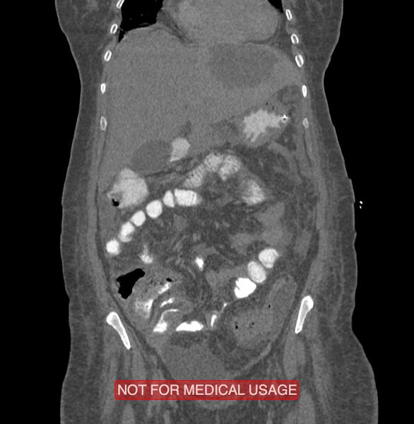 File:Amoebic enterocolitis with liver abscess (Radiopaedia 35100-36609 B 57).jpg