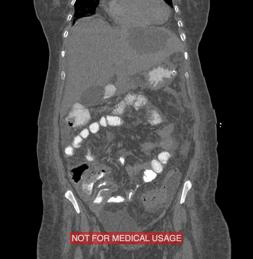 Amoebic enterocolitis with liver abscess (Radiopaedia 35100-36609 B 57).jpg