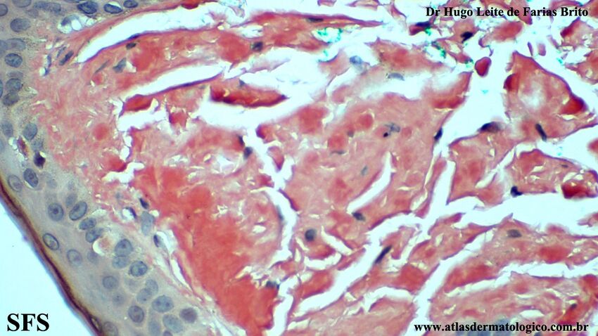 Amyloidosis-Nodular Amyloidosis (Dermatology Atlas 24).jpg