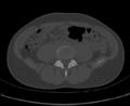 Aneurysmal bone cyst of ischium (Radiopaedia 25957-26094 Axial bone window 6).png