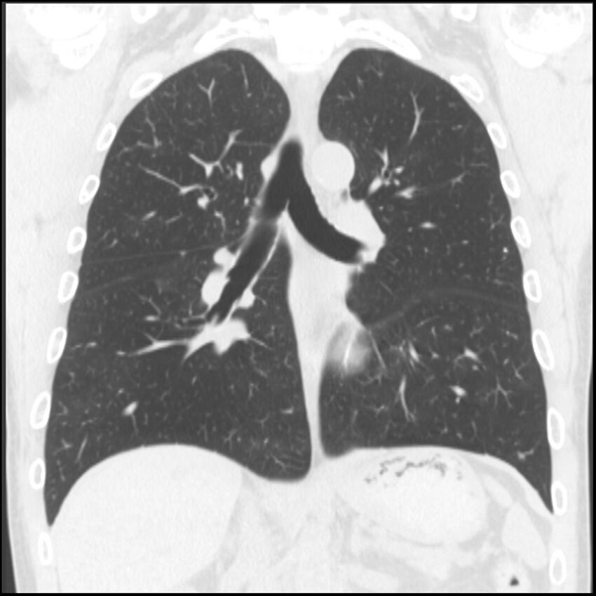 Angioinvasive aspergillosis (Radiopaedia 43957-47466 Coronal lung window 43).jpg