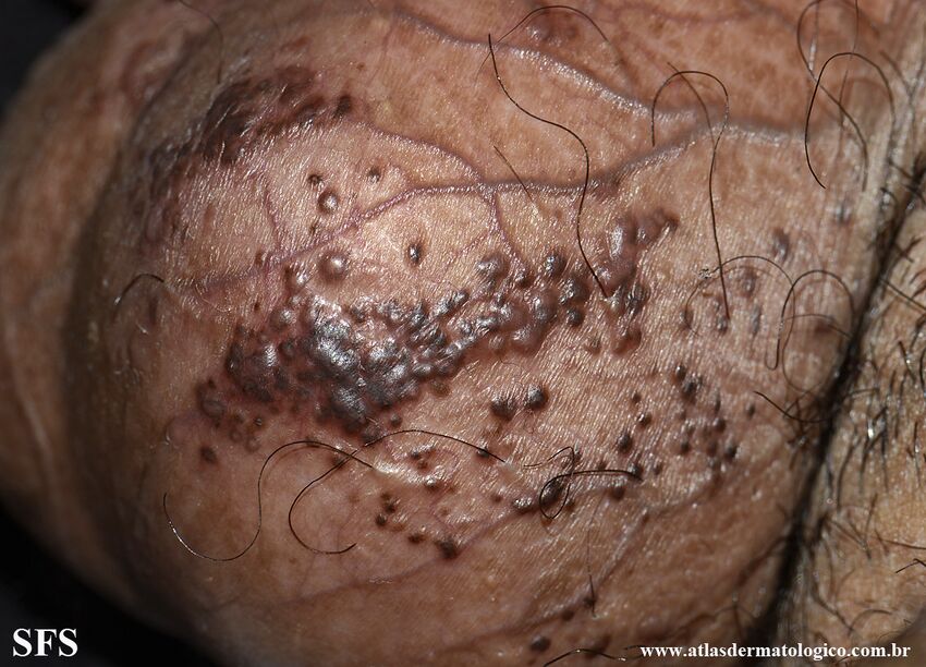 Angiokeratoma Of The Scrotum (Dermatology Atlas 17).jpg