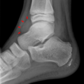 Ankle joint effusion (Radiopaedia 10534-11000 A 1).png