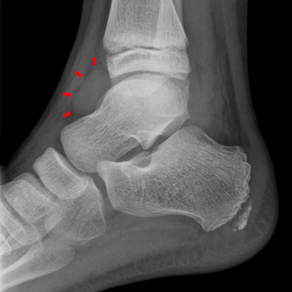 File:Ankle joint effusion (Radiopaedia 10534-11000 A 1).png
